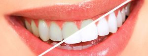 Teeth Whitening