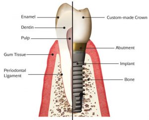 dental implant diagram