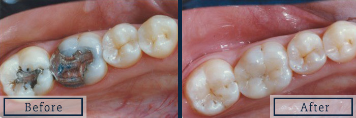 CEREC porcelain onlay