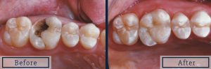 CEREC porcelain onlay