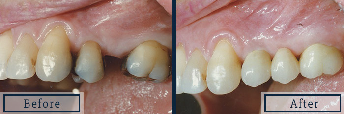 porcelain bridge replace missing molar