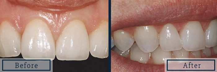 porcelain veneers